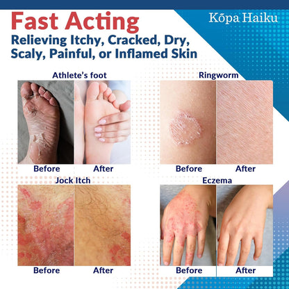 Extra Strength Skin Care Cream for Men and Women   Foot and Body Care(20g) *Exp 3/27*