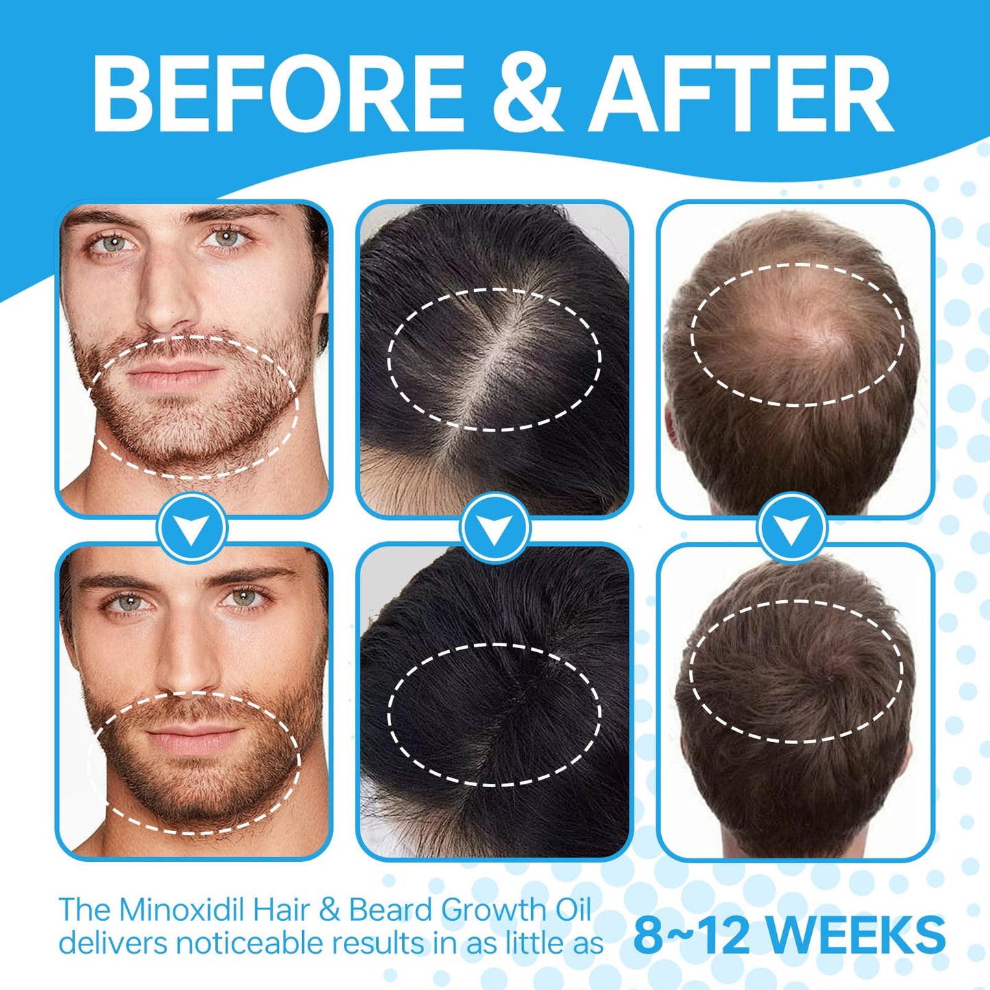 5% Minoxidil Hair Regrowth Treatment for Men & Women
