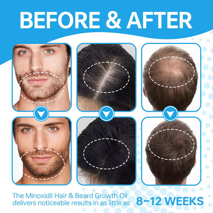 5% Minoxidil Hair Regrowth Treatment for Men & Women