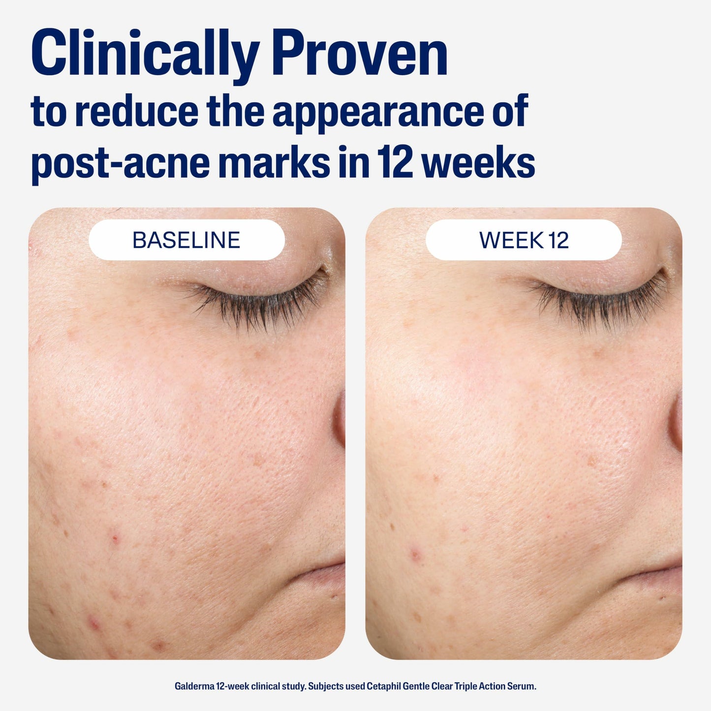 CETAPHIL Gentle Clear Repairing Post-Acne Serumd