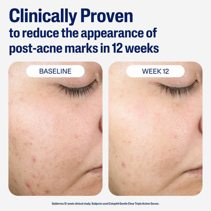 CETAPHIL Gentle Clear Repairing Post-Acne Serumd