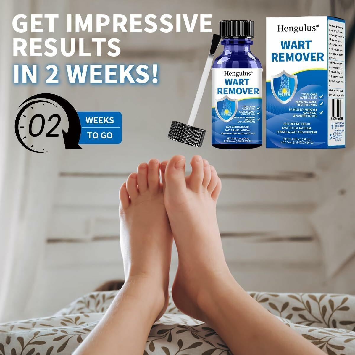 Wart Removal Cream, Salicylic Wart Remover