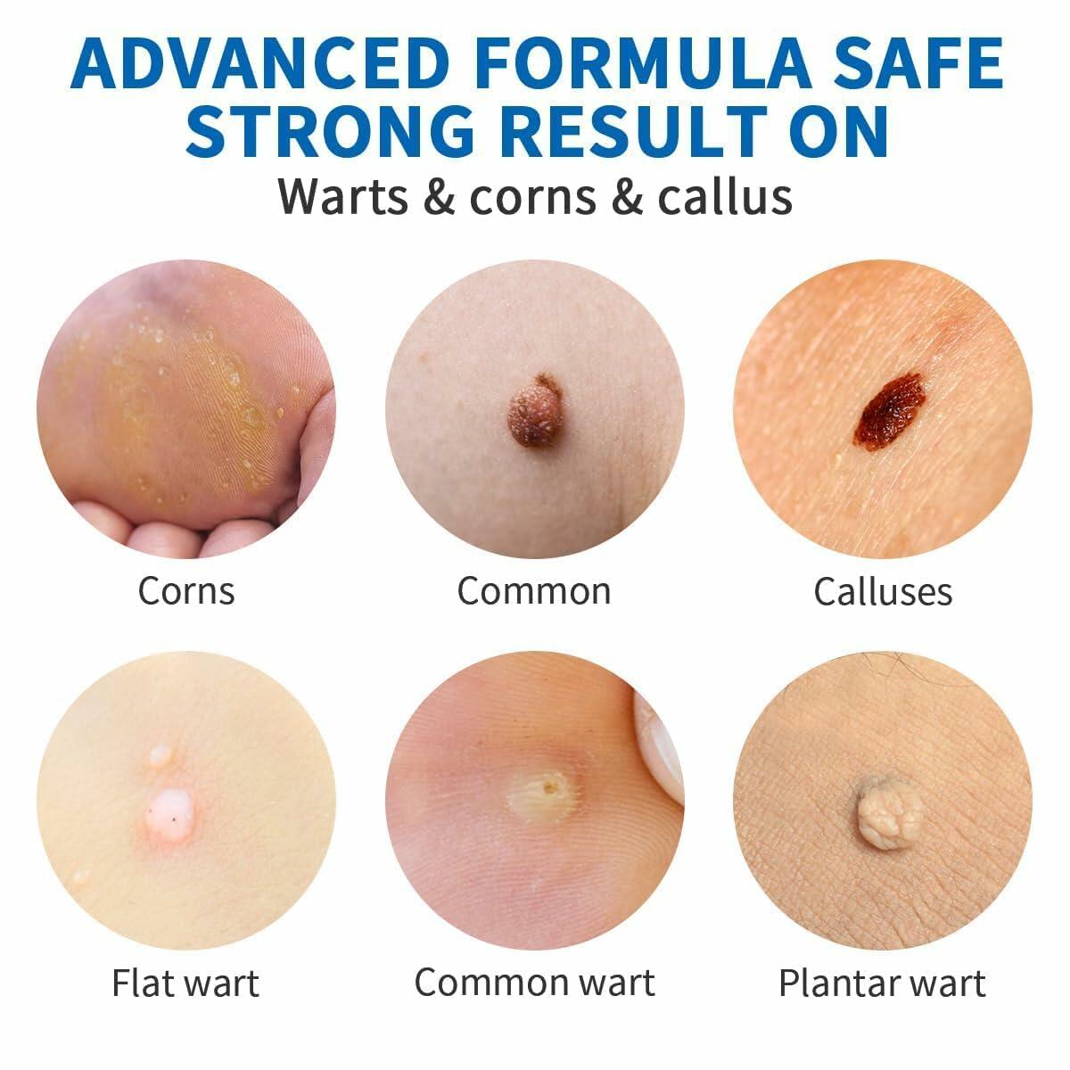 Wart Removal Cream, Salicylic Wart Remover