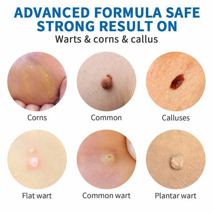 Wart Removal Cream, Salicylic Wart Remover