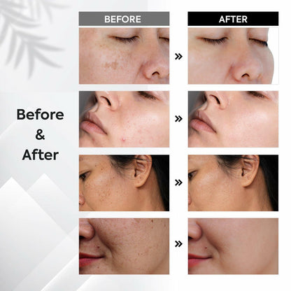 Dark Spot Remover for Face and Body